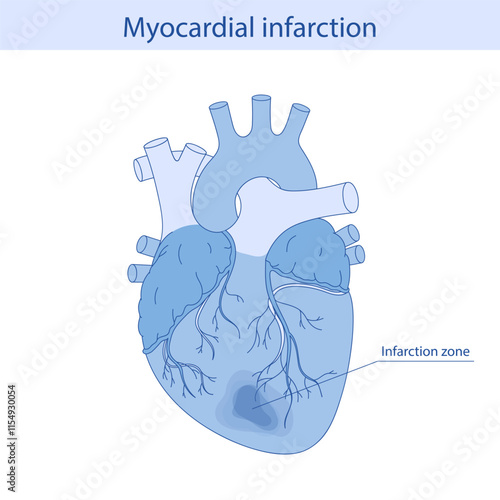 Myocardial infarction. Illustration of a human heart. Heart attack. Illustration in cartoon style