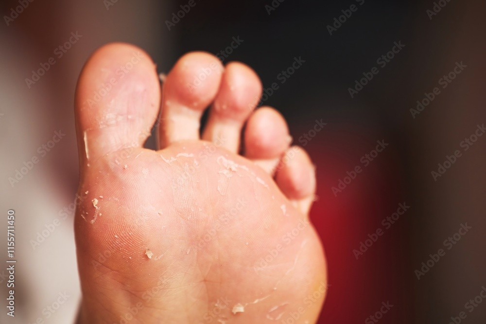 Fototapeta premium Feet with peeling skin after pedicure in a clinic