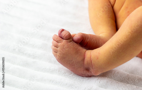 jaundice of newborns, Neonatal jaundice is yellowish discoloration of skin in newborn. disease of newborns. peeling skin, acne, sores.