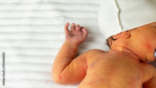 jaundice of newborns, Neonatal jaundice is yellowish discoloration of skin in newborn. disease of newborns. peeling skin, acne, sores.