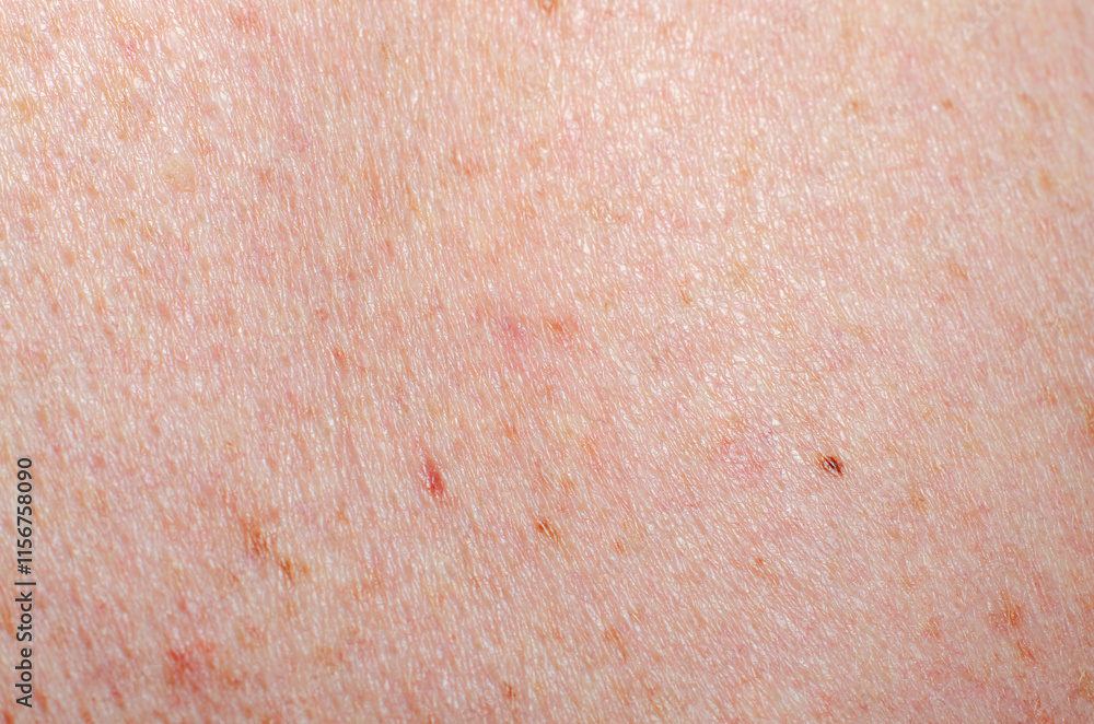Fototapeta premium Nevus on human skin close-up