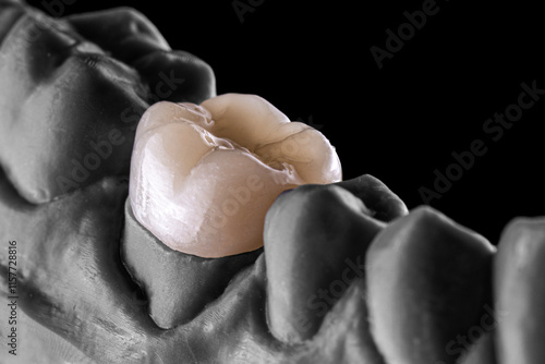 3d printed emax ceramic full crowns