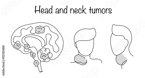Head and neck tumors