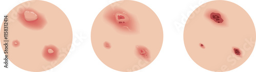 Bild auf Leinwand Chickenpox of Stage on Skin