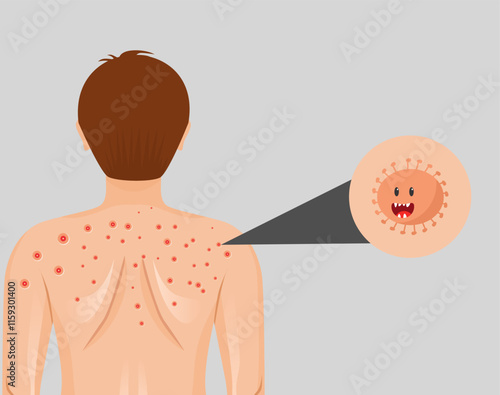 illustration of skin disease caused by germs or bacteria