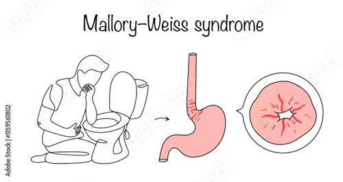 Mallory–Weiss syndrome