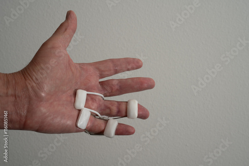 Finger straigheners after Dupuytren operation. Fingers that remained in a bent position for a long time during the Dupuytren contraction are going to be straightened again by constant pressure.