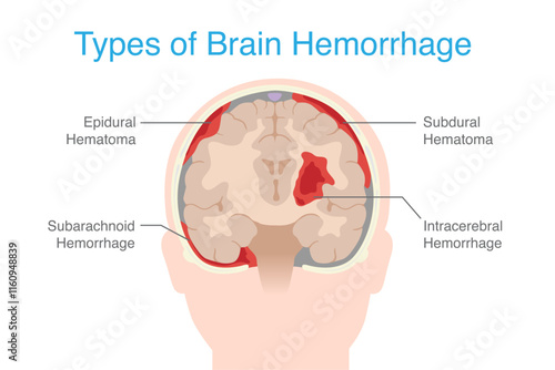 Types Brain hemorrhage inside skull of including Epidural hemorrhage, Subdural , Subarachnoid, and Intraparenchymal. Anatomy of human brain hemorrhage.