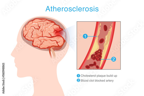 Intracranial atherosclerosis disease. Cholesterol plaque and fat build up at artery make blood clod blocked artery.