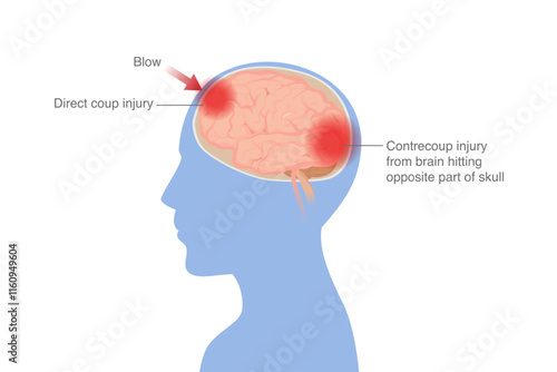 Direct injury point after blow head and Contrecoup injury from brain hitting opposite part of skull. Medical diagram of damaged area is inside the brain tissue.