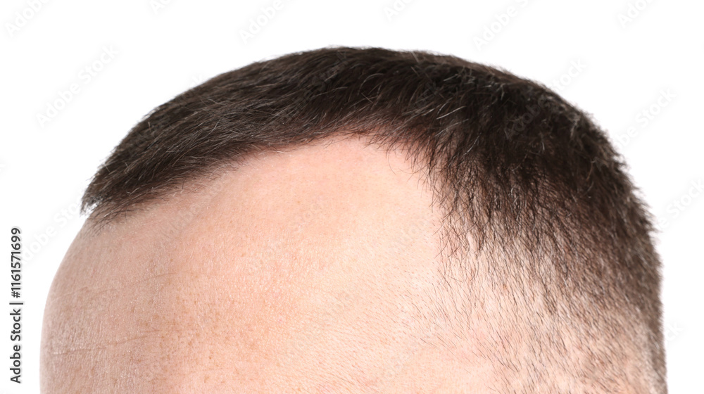Obraz premium Baldness problem. Man with receding hairline on white background, closeup