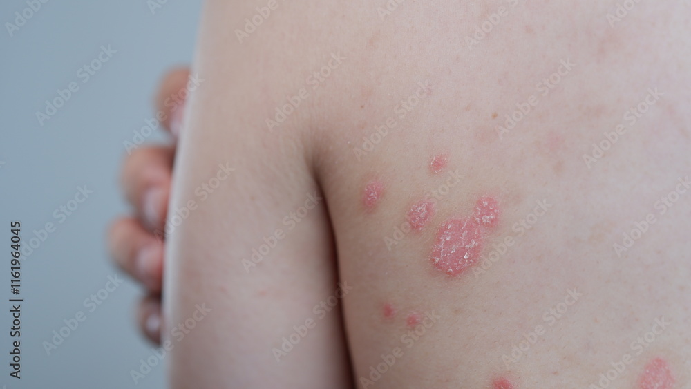Fototapeta premium Small patches of Psoriasis in a man's back. Skin with psoriasis.