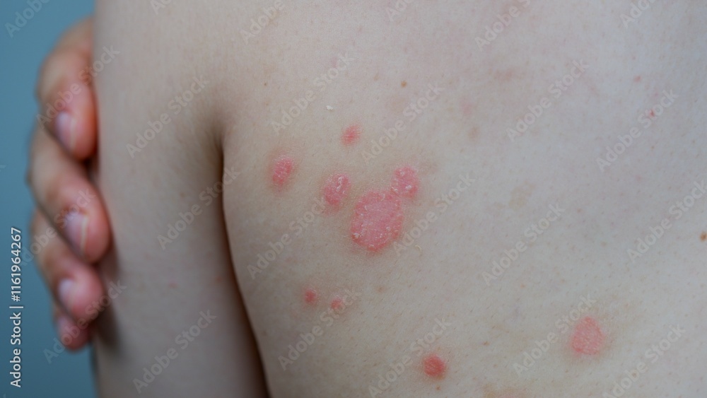 Small patches of Psoriasis in a man's back. Skin with psoriasis. Small patches of Psoriasis in a man's back. Skin with psoriasis.
