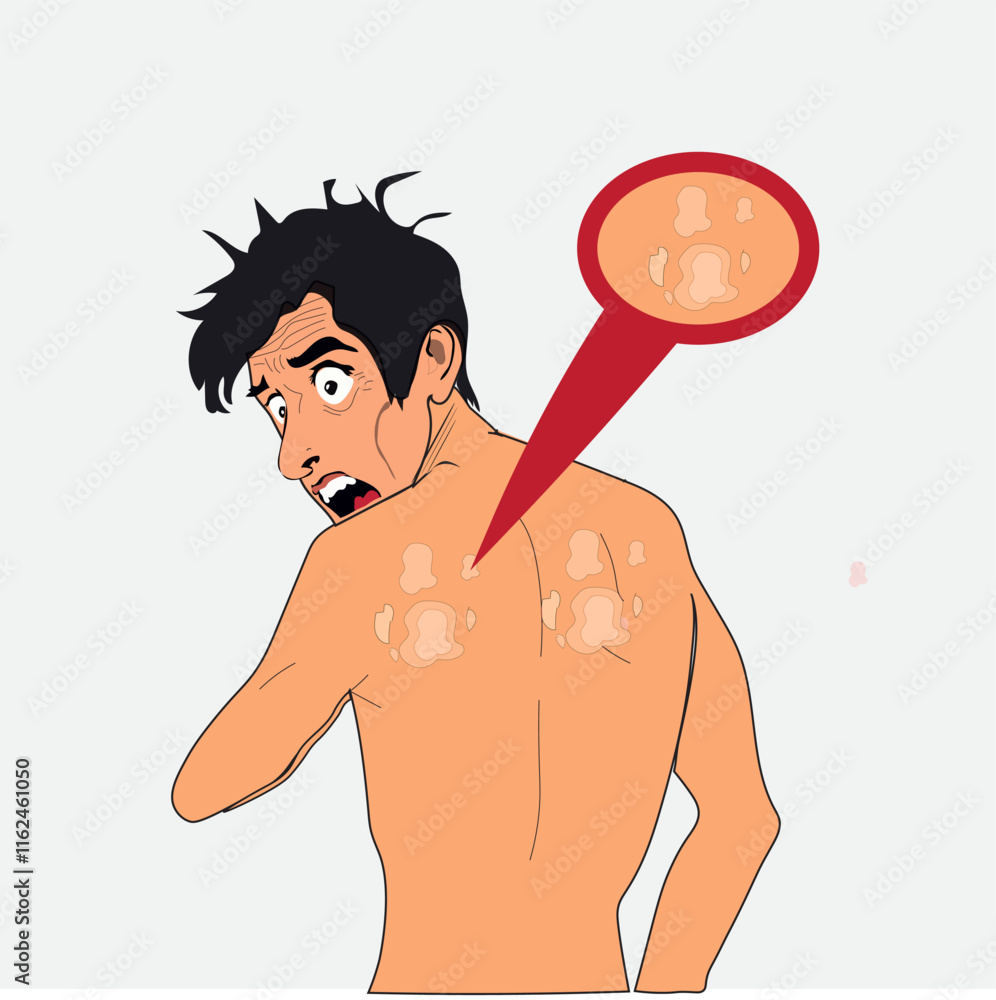 Fototapeta premium The man was shocked to see ringworm on his back, on his back.