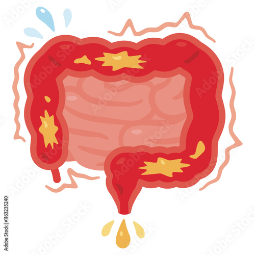 動きが過敏で下痢になる腸のイラスト