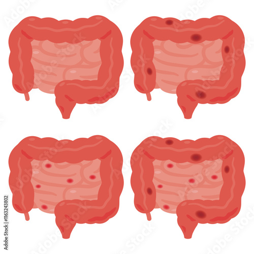 炎症が起きた大腸と小腸のイラスト