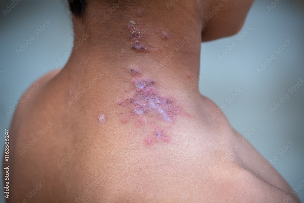 Fototapeta premium Close-Up of Skin Infection on the Neck