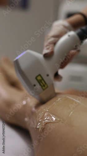Diode laser hair removal on female legs for smooth skin, beautician performing treatment at clinic