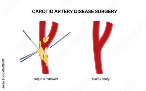 Carotid artery surgery
