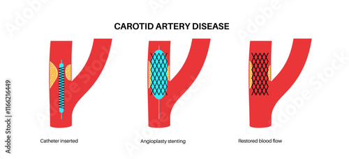 Carotid artery surgery