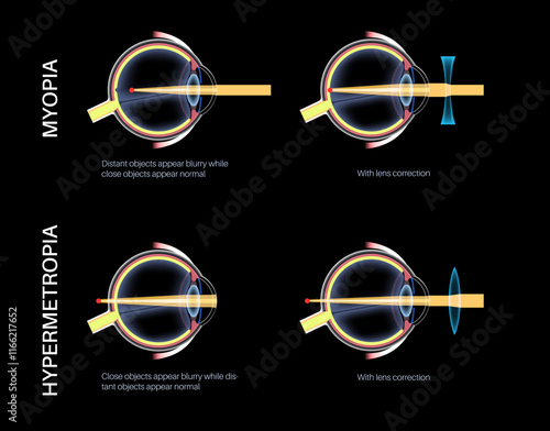Farsightedness and nearsightedness correction