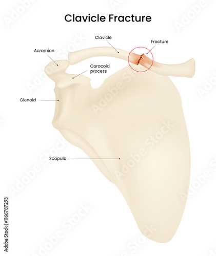 Causes and Symptoms of Clavicle Fracture