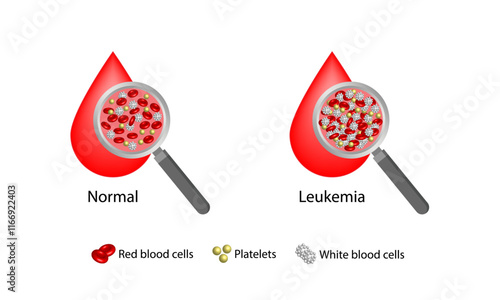 Leukemia, blood cancer. Difference between healthy normal blood and blood cancer. Blood droplet, erythrocytes, platelets and lymphocytes. Vector illustration.