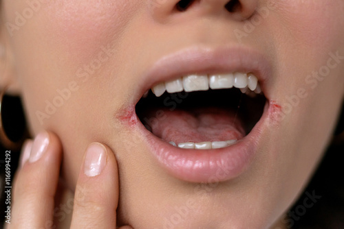 Canvas Print Close up of woman having problem with mouth disease, dry skin on corner of chapp