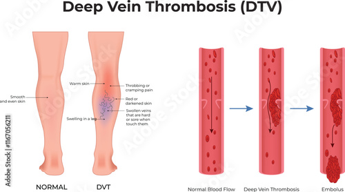 Deep Vein Thrombosis Design Vector Illustration