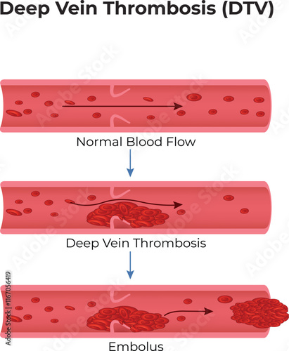 Deep Vein Thrombosis Design Vector Illustration