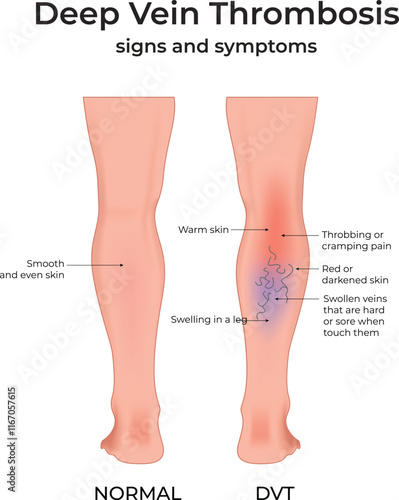 Deep Vein Thrombosis Signs and Symptoms Design Vector Illustration