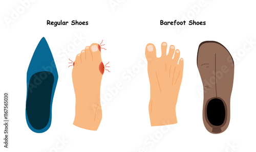 Barefoot Shoes.  Feet with Bunions.  Compare regular narrow shoes and barefoot shoes. Tight shoes and heels lead to problems with the feet, bone deformation, redness and inflammation