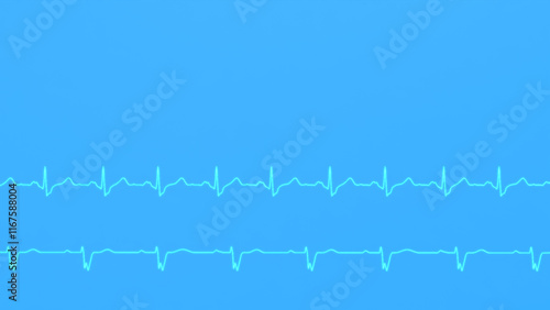 ECG of cardiac arrhythmias. Right bundle branch block and left bundle branch block.