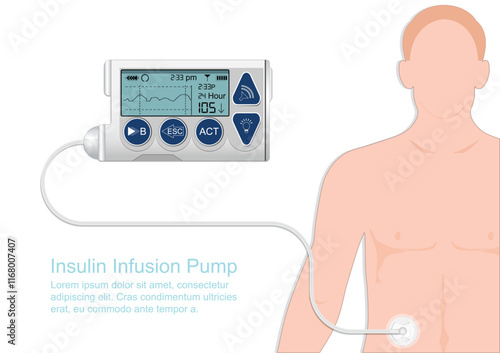 Insulin infusion pump is device that simulates the function.