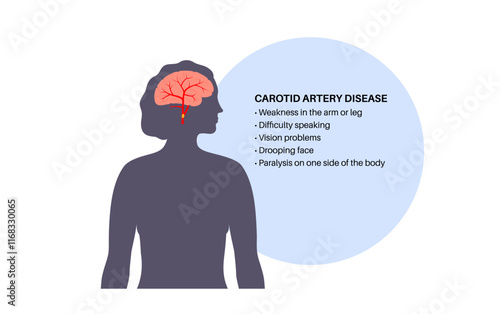 Carotid artery disease