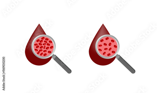Iron deficiency anemia. Normal blood and anemia. Blood droplet. Blood donation. Realistic vector 3d picture. Vector illustration isolated on white background.