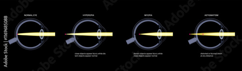Refractive errors poster