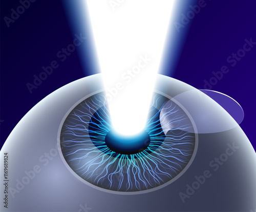 LASIK eye surgery