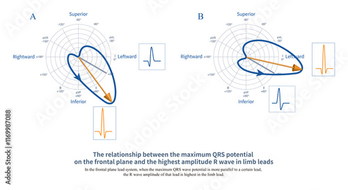 In the frontal plane lead system, when the maximum QRS wave potential is more parallel to a certain lead, the R wave amplitude of that lead is highest in the limb lead. photo