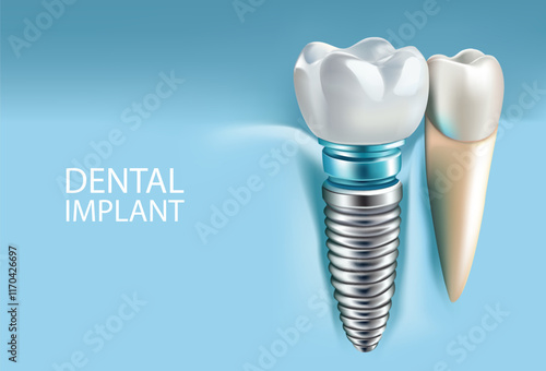 Dental implants on a light blue background, Vector illustration