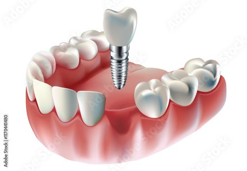 Tooth implant, tooth restoration, on white background, Vector illustration