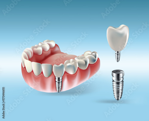 Tooth implant, tooth restoration, on light blue background, Vector illustration