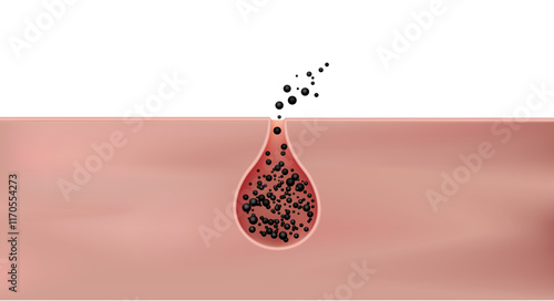 Blackhead treatment dissolves oil. blackhead removal. absorbs dirty skin.