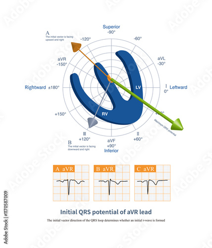 In the aVR lead, the QRS wave can be in the form of QS, rS, Qr, rsr, etc., with the main wave being negative. photo