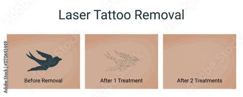 Laser Tattoo Removal Procedure, vector illustration