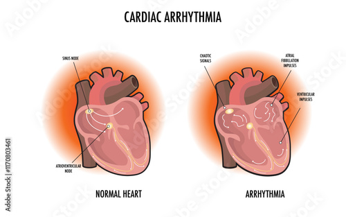 heart arrhythmia information health care chart