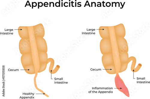 Appendicitis Anatomy Design Vector Illustration
