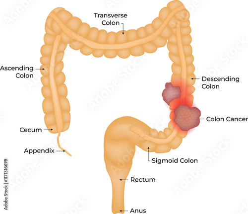 Appendectomy Appendicitis Anatomy Design Vector Illustration