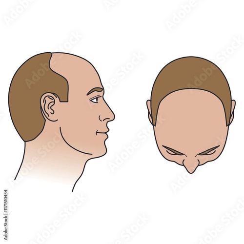 Stage 4 (Anterior) on The Norwood-Hamilton Scale of Male Hair Loss