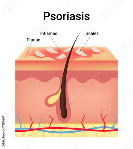 Causes and Symptoms of Psoriasis